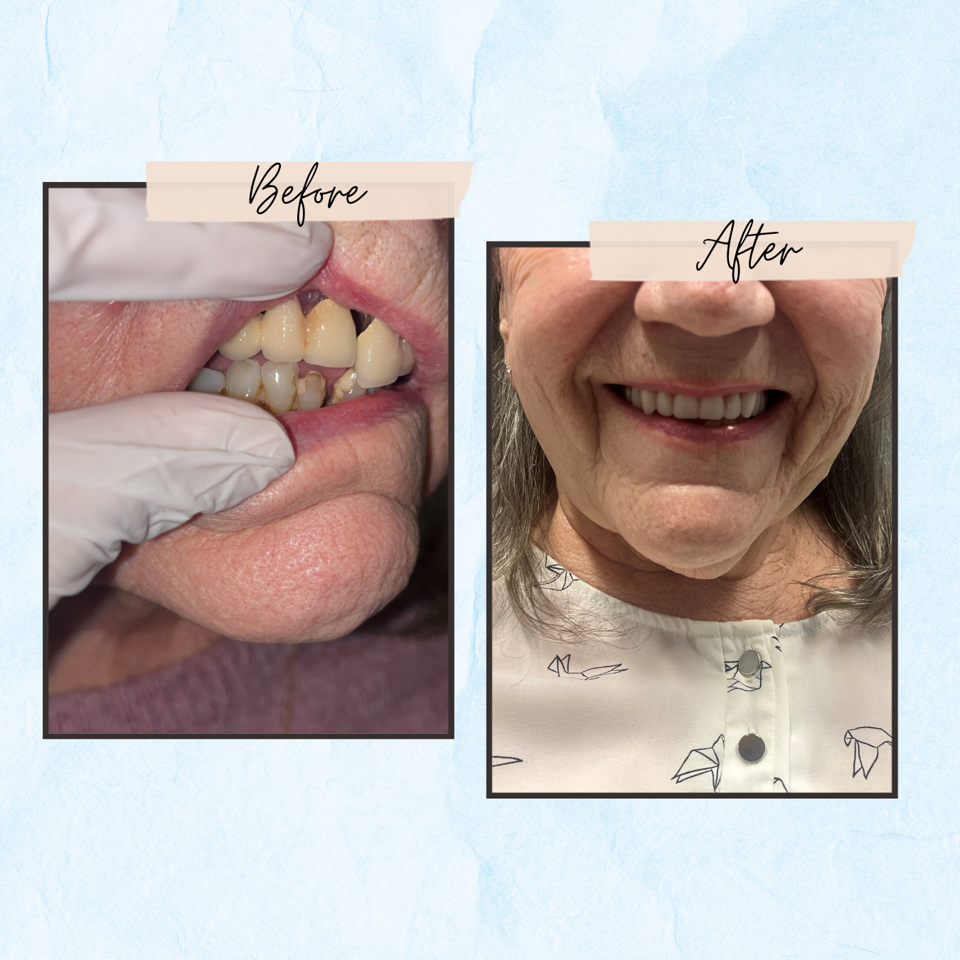 Before and After Gallery - Mountview Denture Clinic