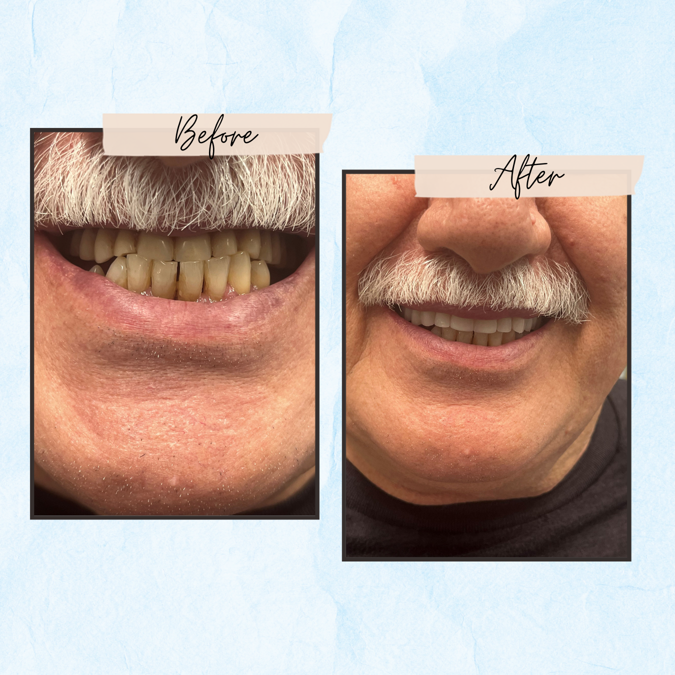 Before and After Gallery - Mountview Denture Clinic