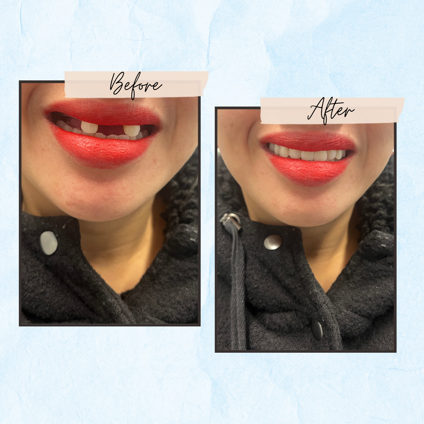 A before and after photo of a woman 's teeth