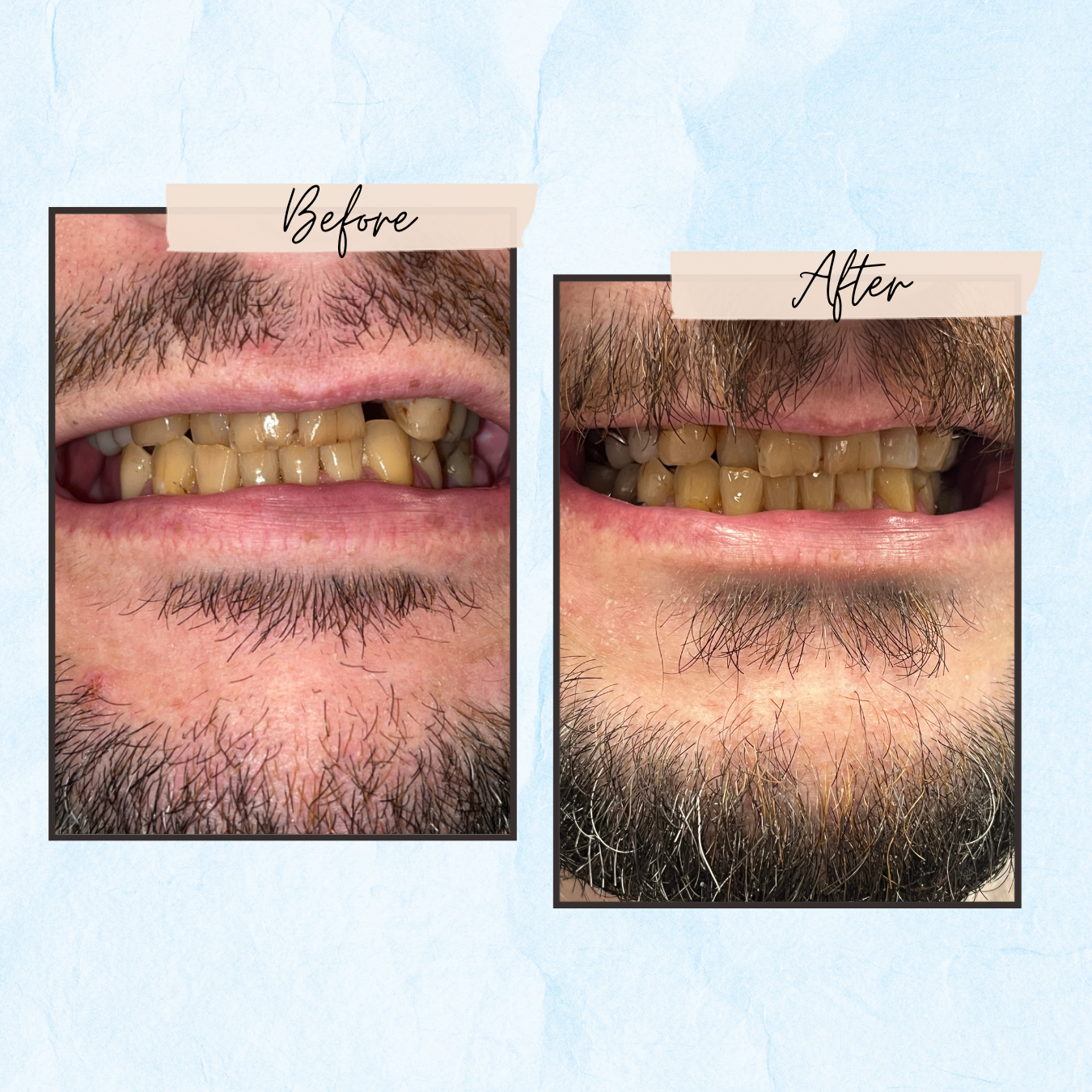 Before and After Gallery - Mountview Denture Clinic