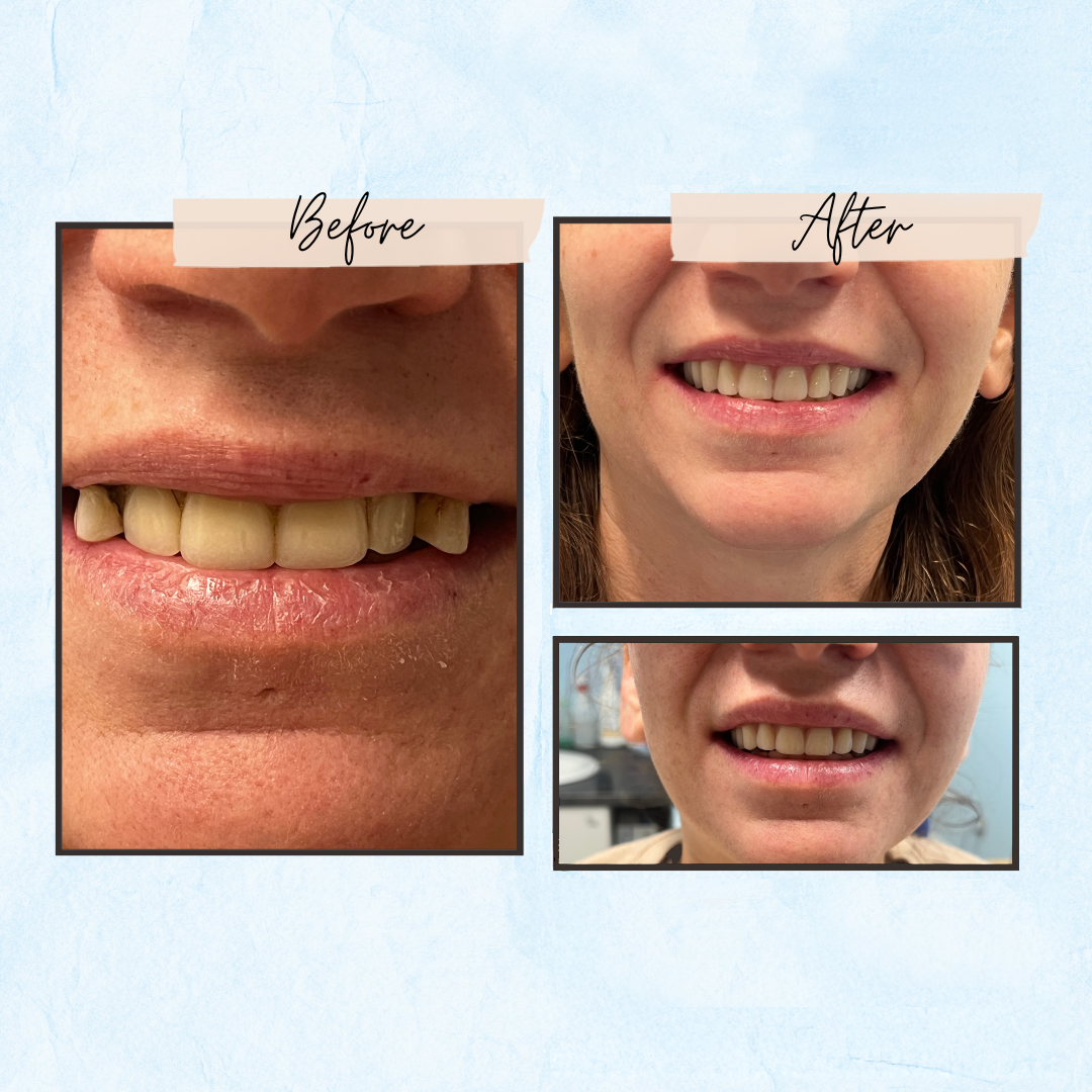 Before and After Gallery - Mountview Denture Clinic