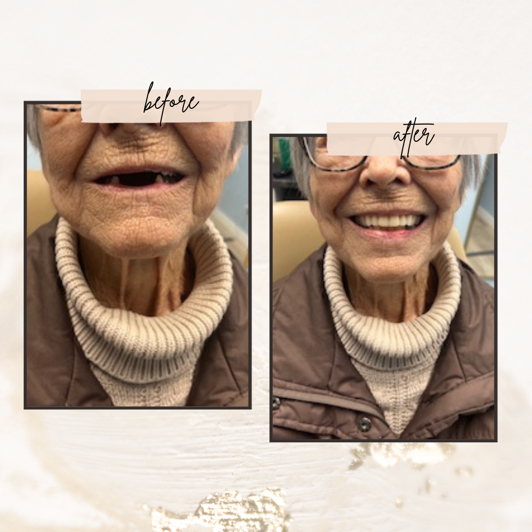 before and after smile tranformation complete upper denture