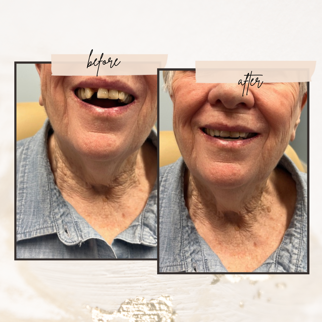 one tooth partial denture
