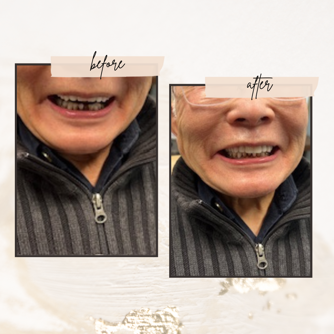 smile tranformation partial denture-1920w