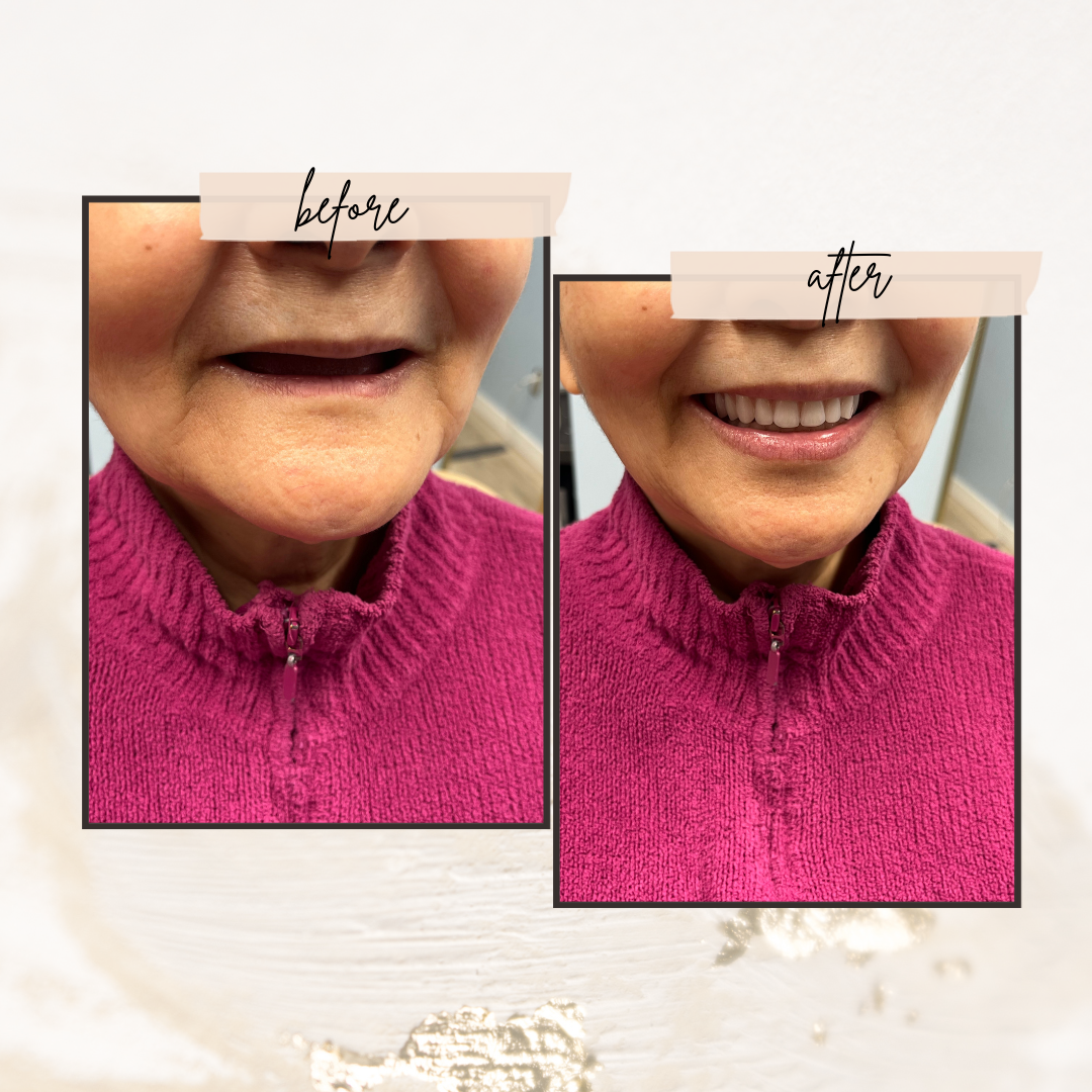 smile transformation precision complete dentures-1920w