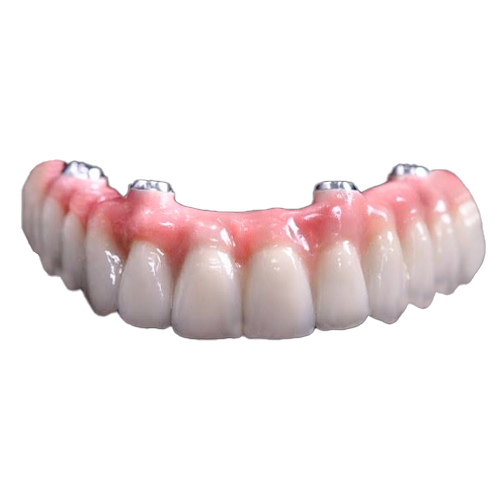 Denture Implants