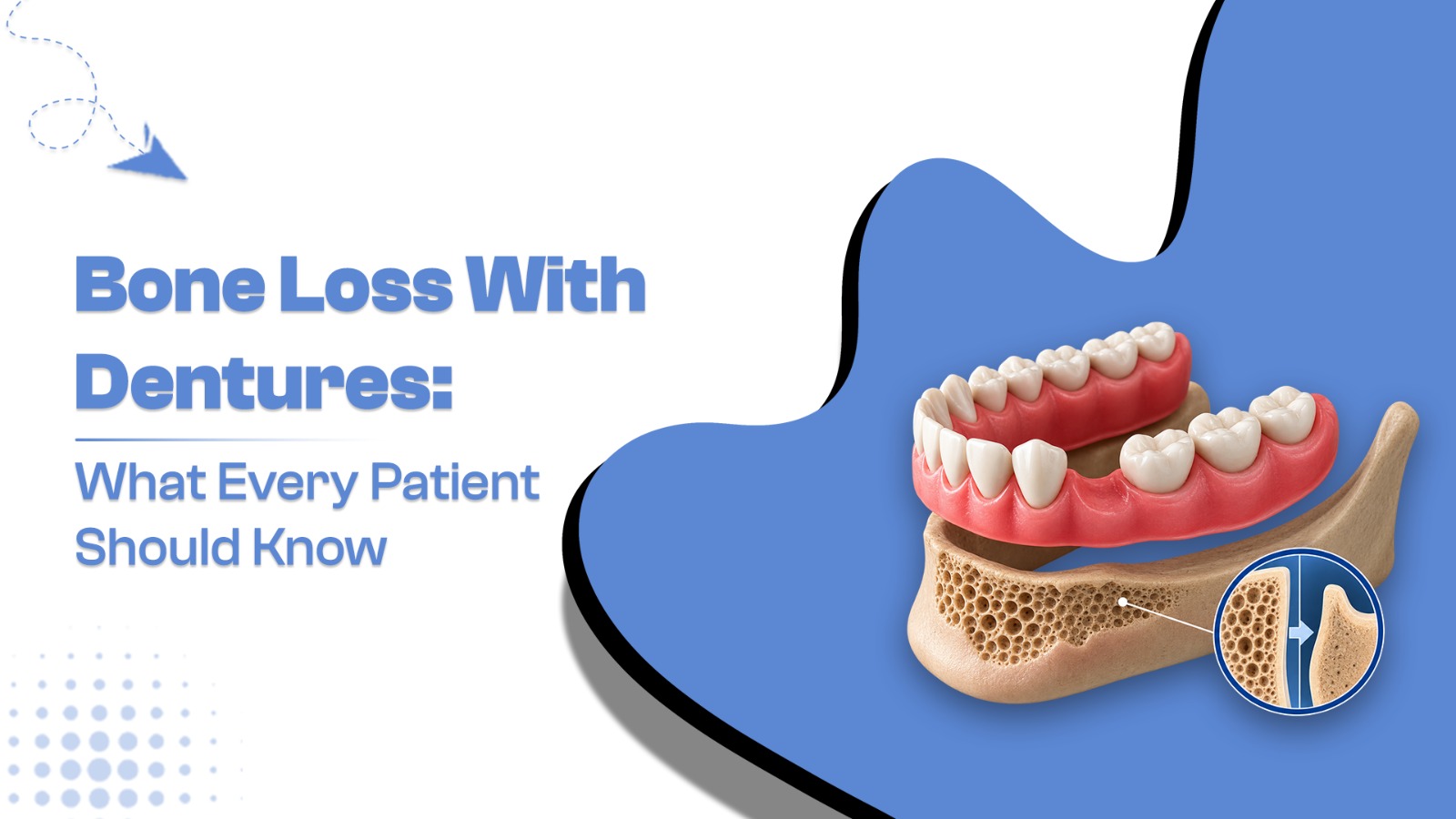 bone loss with dentures